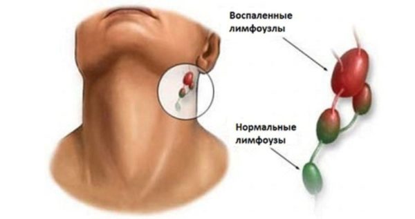 Воспаление и отек лимфатических узлов при ветрянке у детей и взрослых 1