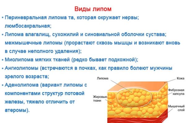 Липома: что это такое, причины возникновения, симптомы, методы терапии 5