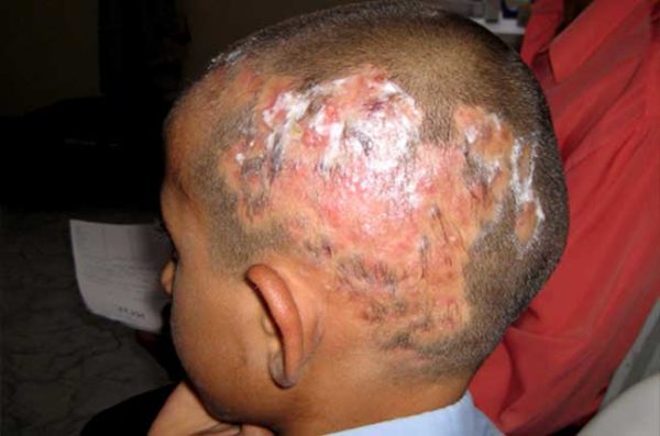 Грибок на голове: как распознать, избавиться от зуда и шелушения