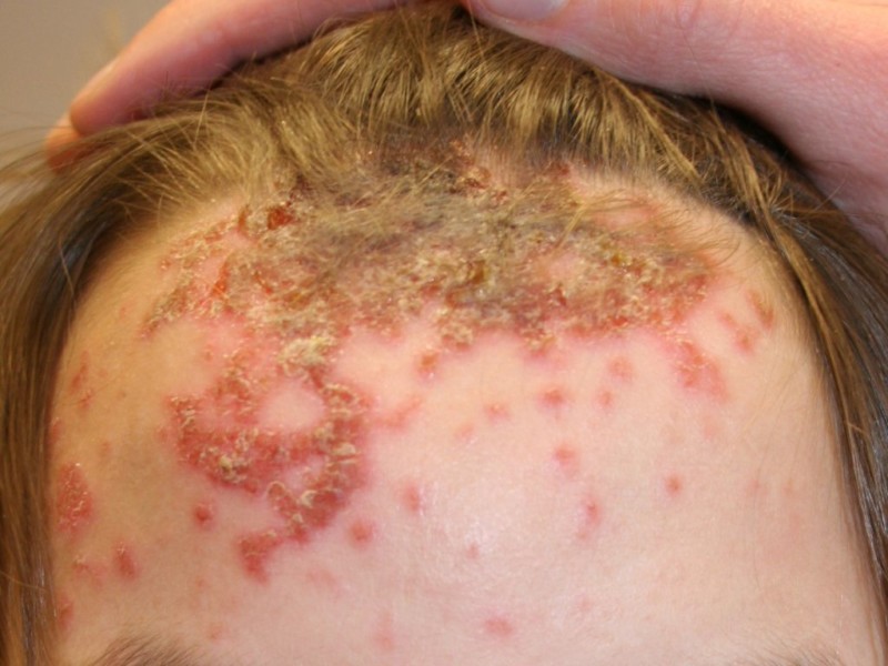 Стрептококковая пиодермия у детей: признаки, лечение стрептококковой пиодермии в домашних условиях3