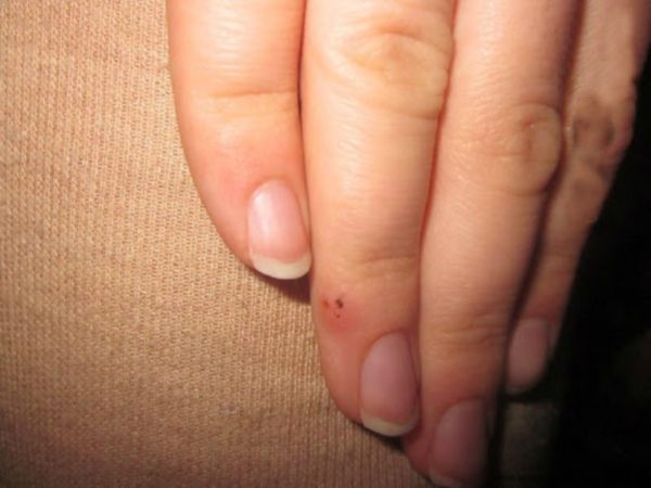 Удаление кондилом жидким азотом: прижигание при криодеструкции 3