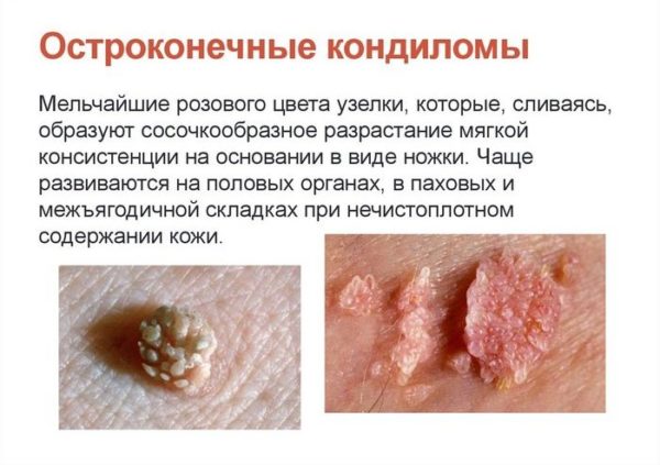 Остроконечные кондиломы: удаление в домашних условиях 3
