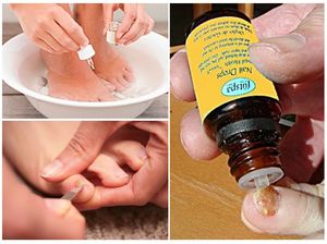 Применение эфирного масла чайного дерева для грибов: полезные свойства, простые рецепты лечения