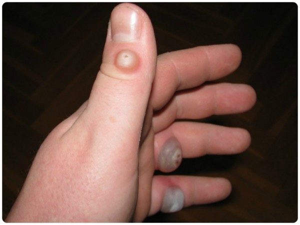 Удаление кондилом жидким азотом: прижигание при криодеструкции 2