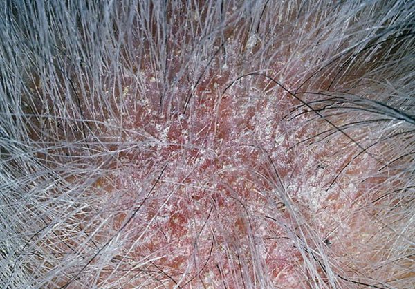 Грибок на голове: как распознать, избавиться от зуда и шелушения