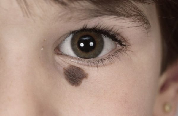 Виды родинок у человека: доброкачественные и злокачественные 16