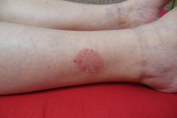 Зуд в ногах ниже колен: причины и лечение болезни 3