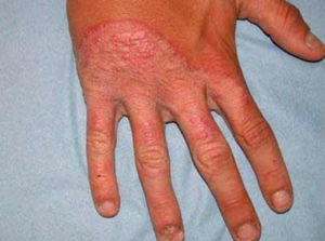 Лечение грибка рук: признаки и симптомы кожных заболеваний, методы лечения