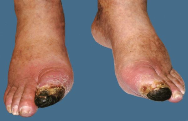 Трофическая язва голени при сахарном диабете: лечение, диета в домашних условиях 3