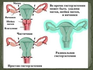 Методы удаления миомы матки Операция по удалению миомы матки