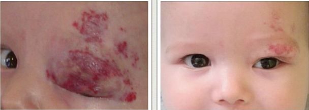 Гемангиома у новорожденных: что это такое, причины возникновения, каковы методы лечения