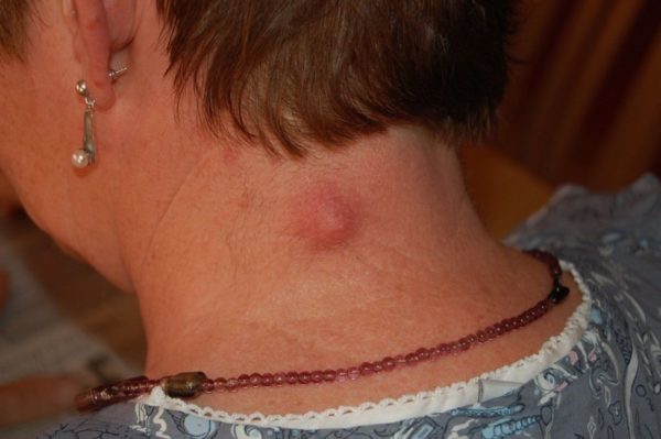 Атерома: лечение в домашних условиях без хирургического вмешательства, например, распространение опухоли 1