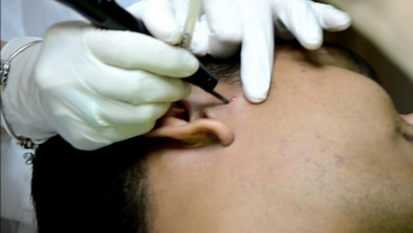 Упал крот: причины, первая помощь, методы лечения9