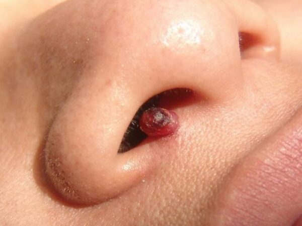 Папиллома в носу: удаление в домашних условиях, меры предосторожности 1