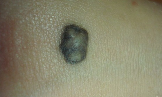 Невус: что это такое, причины образования, виды, симптомы возрождения7