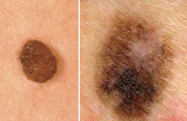 Как проверить невус на онкологию, доброкачественное образование или злокачественное, как проводится анализ, что такое соскоб и биопсия