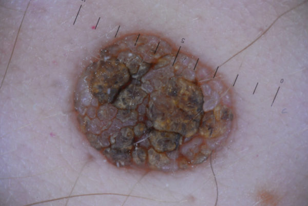 Виды родинок у человека: доброкачественные и злокачественные 7