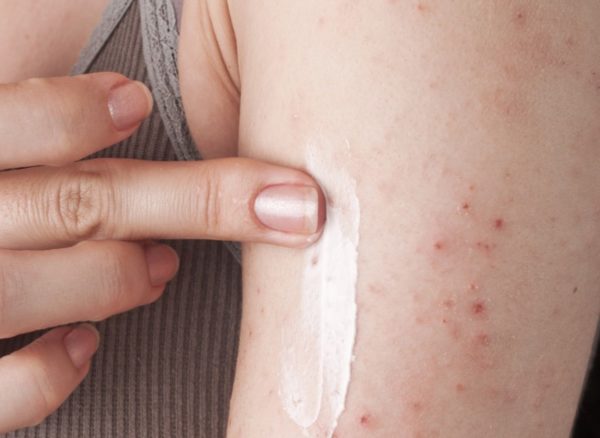 Зуд во время беременности: причины появления, например, смазывание кожи, чтобы избавиться от него 2