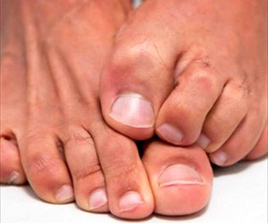 Грибок на ногтях стоп и рук: как выявить заболевание, выделить стадии развития