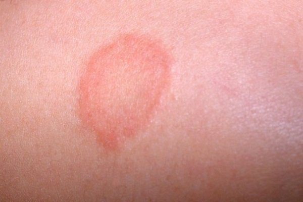 Розовый лишай: симптомы, причины и диагностика болезни