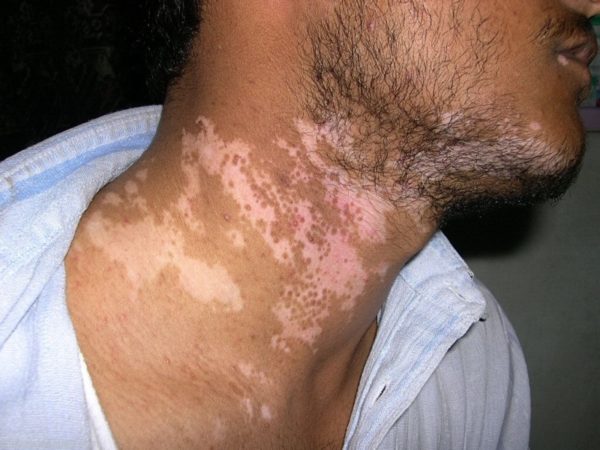 Витилиго: традиционное лечение, причины, симптомы 1