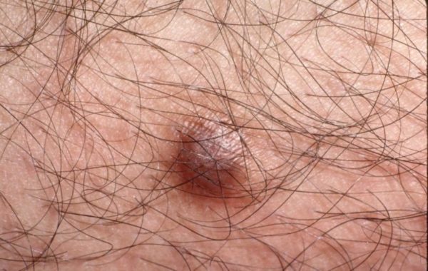 Анализ на ВПЧ у мужчин и женщин: как делать, расшифровка результатов 3