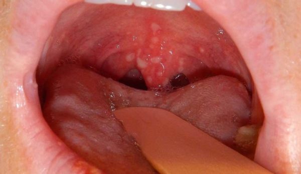 Вирус Коксаки: причины, симптомы, формы и особенности лечения 1