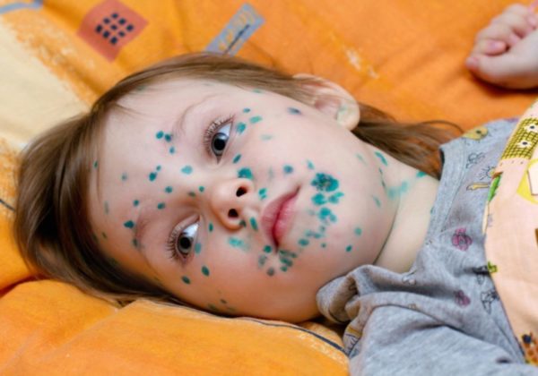 Как заразить ветрянку: продукты для лица, тела, глаз и рта