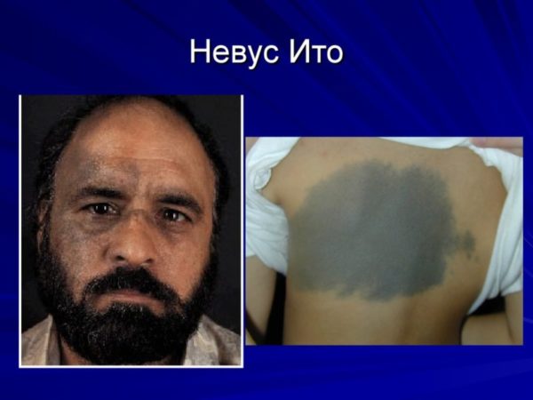 Невус: что это такое, причины образования, виды, симптомы возрождения 10