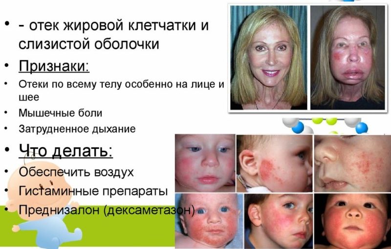 Отек Квинке: симптомы у детей, как оказать первую помощь 1