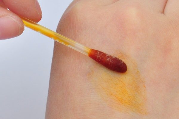 можно ли прижигать папилломы йодом: лечение и удаление5