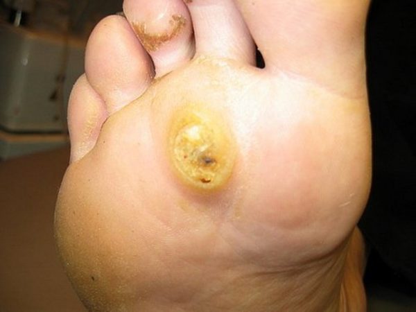 Бородавка воспалена и болит: что делать в домашних условиях