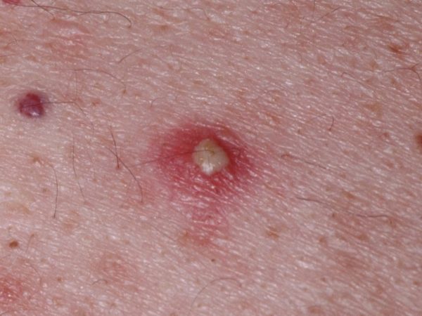 Остиофолликулит: лечение и профилактика стафилококкового импетиго 2