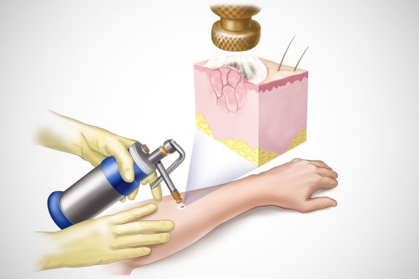 Удаление папиллом жидким азотом 4