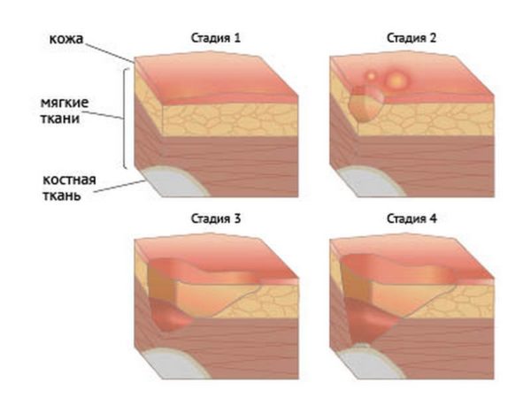 Лечение трофической язвы голени при варикозном расширении вен 1