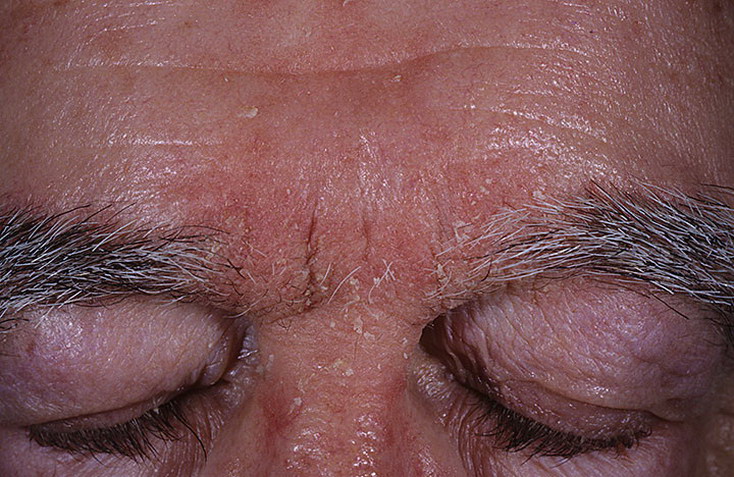 Себорейный дерматит заразен или нет: перхоть передается от человека к человеку через расческу