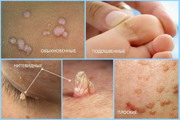 Бородавки на лице: как избавиться от них в домашних условиях