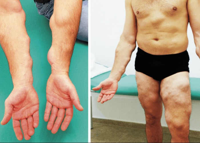 Липоматоз кожи: причины появления, лечение болезни0