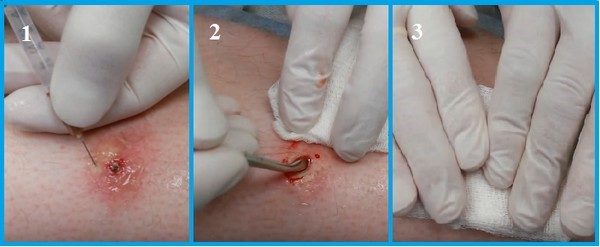 Как извлечь гной из фурункула в домашних условиях 4