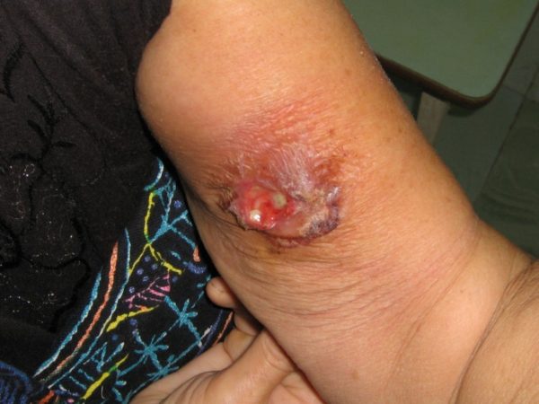 Фурункулез: заразен или не заразен другому человеку 3