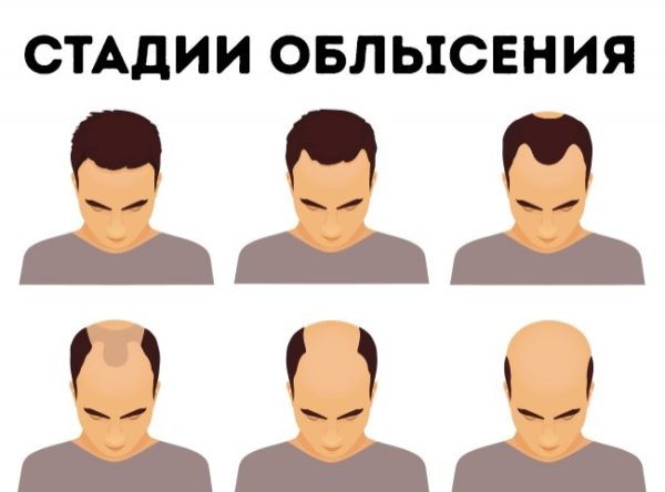 Какое средство от облысения по мужскому типу помогает от выпадения волос и облысения2