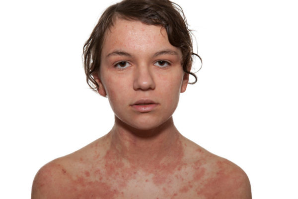 Что такое атопия: причины, симптомы, лечение у детей 1