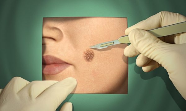 Пигментные пятна на лице: причины и лечение в домашних условиях 6