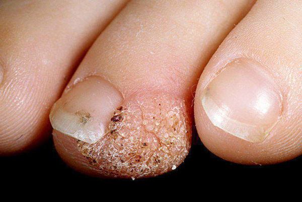 Бородавка на пальце ноги: как она выглядит и какие методы лечения существуют
