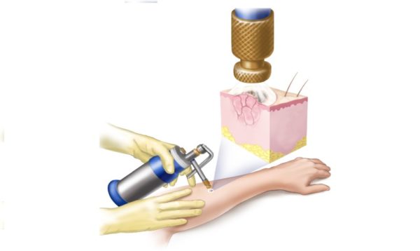 Удаление бородавок лазером или азотом: что лучше, сравнение методов