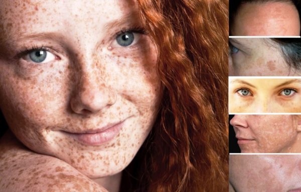 Пигментные пятна на лице: причины и лечение в домашних условиях 4