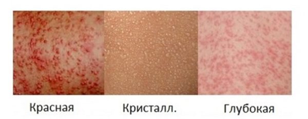 Острая жара на лице у детей: симптомы, лечение, профилактика 2