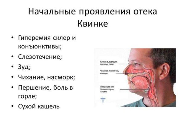 Отек Квинке у детей и взрослых: причины отека Квинке, неотложная помощь при его появлении 4