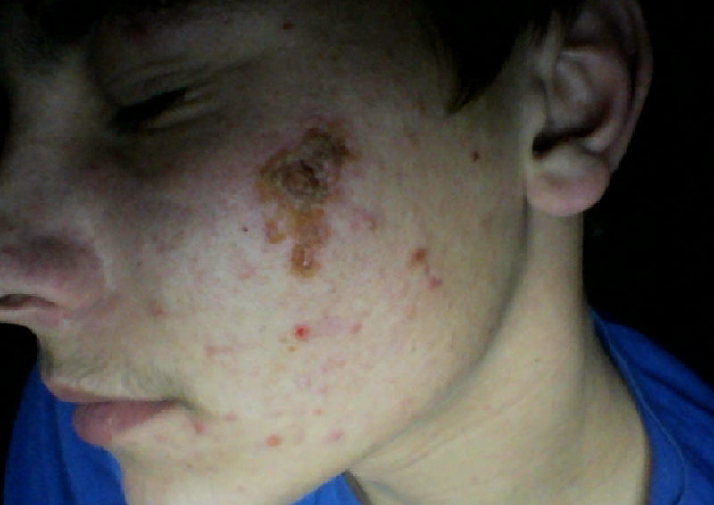 Синтомициновая мазь от прыщей (прыщей): инструкция по применению при прыщах на лице 3