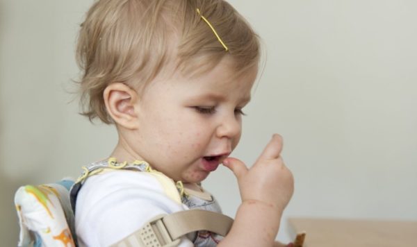 Вирус Коксаки - код по мкб-101